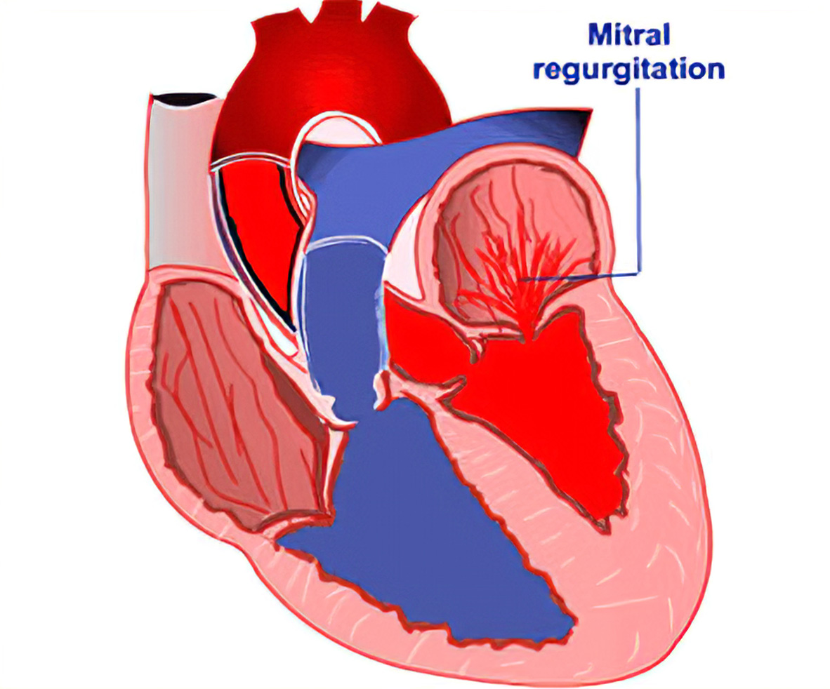 Ayurvedic Treatment For Heart Valve Regurgitation